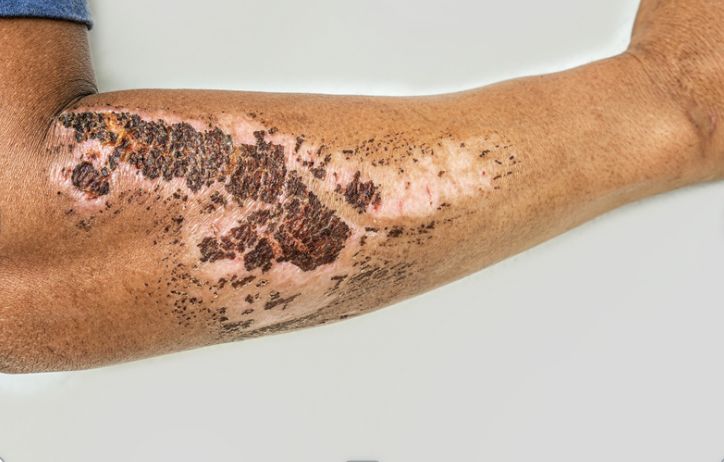Fore arm Burn Wound from Internal Water Heater Snorkel
